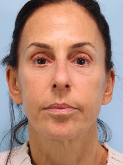 IPL Photofacial Before & After Gallery - Patient 465021 - Image 1