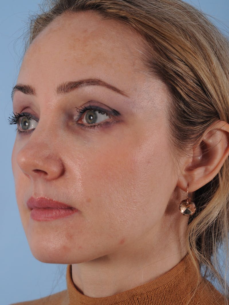 Thread Lift Before & After Gallery - Patient 880204 - Image 4