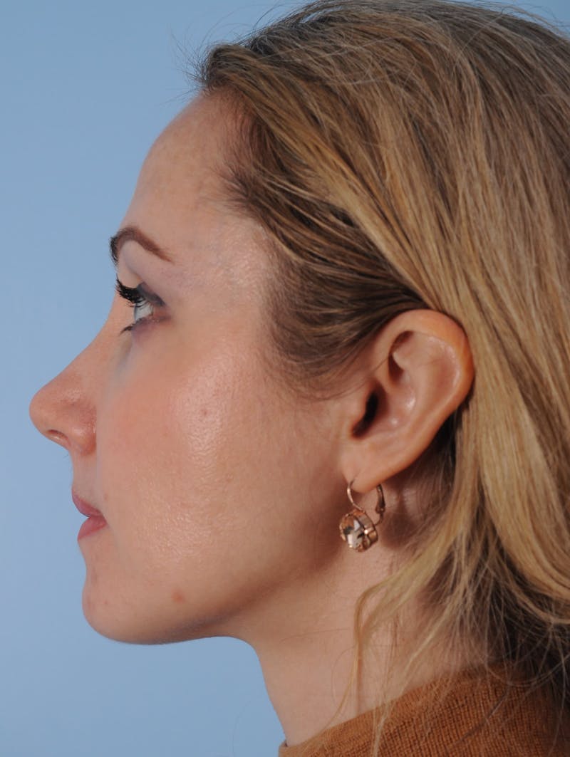 Thread Lift Before & After Gallery - Patient 880204 - Image 6