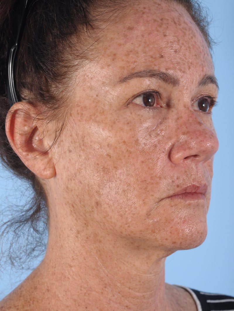 IPL Photofacial Before & After Gallery - Patient 391982 - Image 1