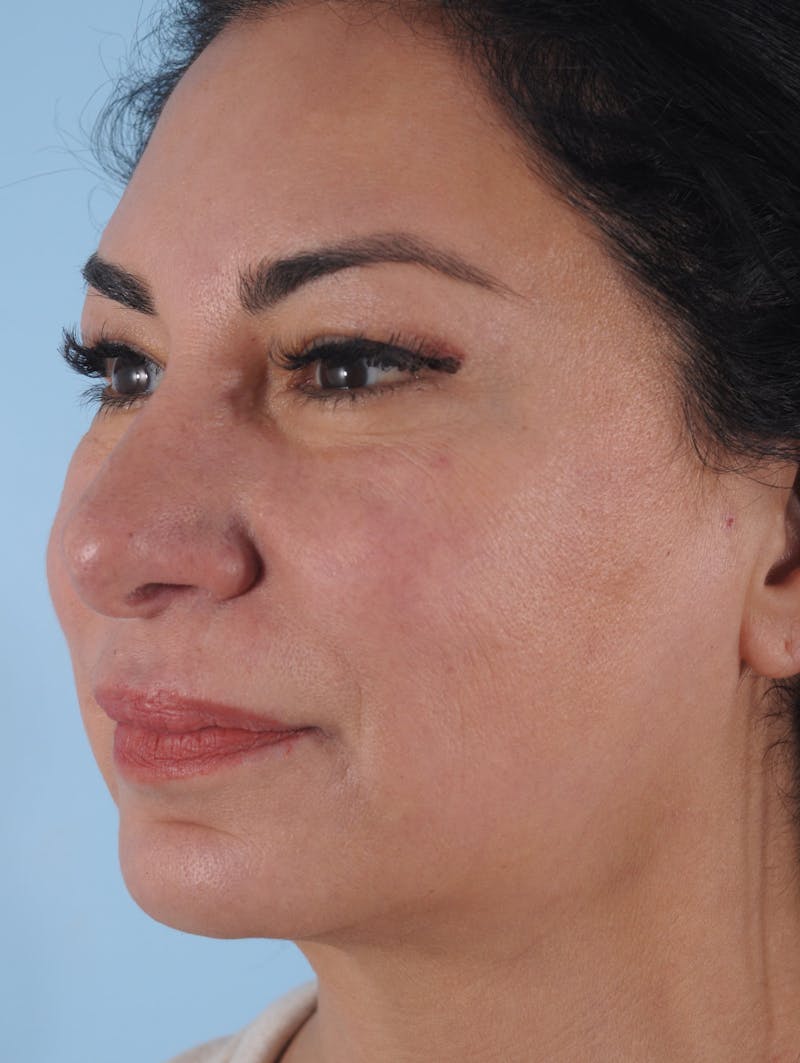 Thread Lift Before & After Gallery - Patient 125609 - Image 3