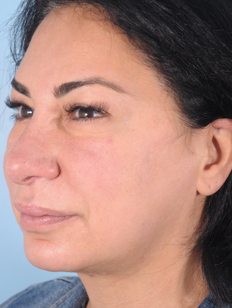 Thread Lift Before & After Gallery - Patient 125609 - Image 4