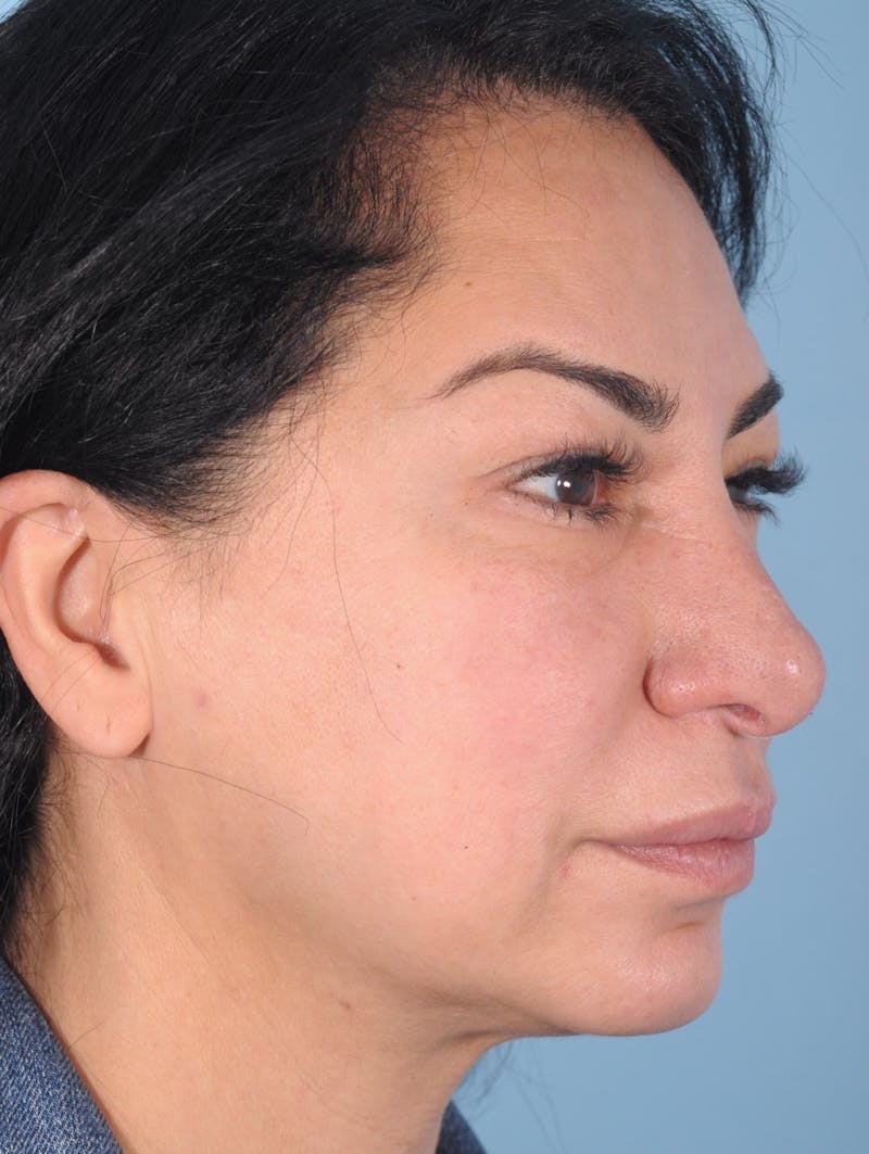 Thread Lift Before & After Gallery - Patient 125609 - Image 6