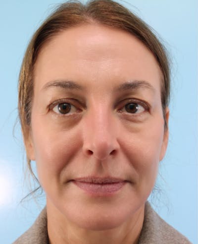 Upper Blepharoplasty Before & After Gallery - Patient 396520 - Image 1