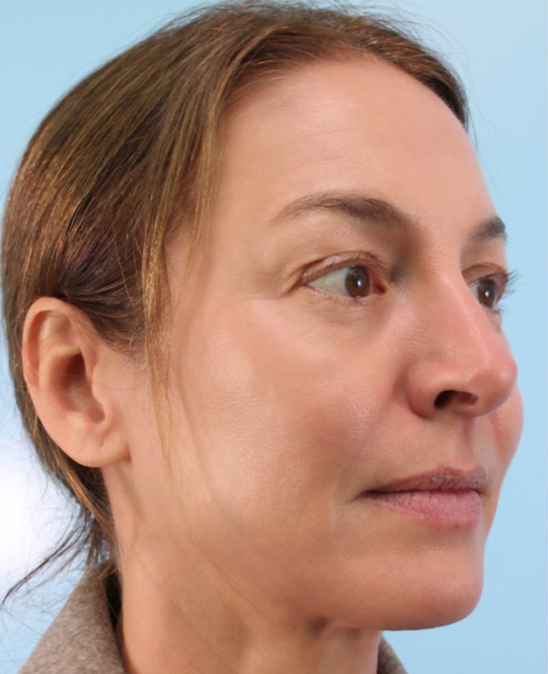 Upper Blepharoplasty Before & After Gallery - Patient 396520 - Image 3