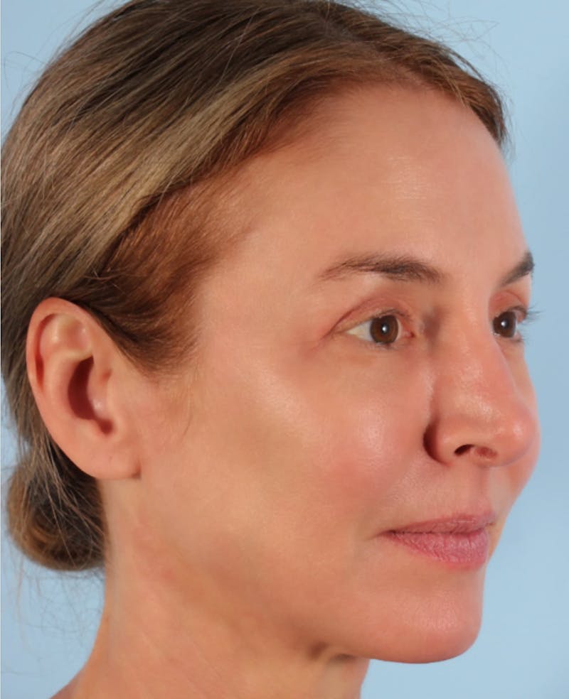 Upper Blepharoplasty Before & After Gallery - Patient 396520 - Image 4