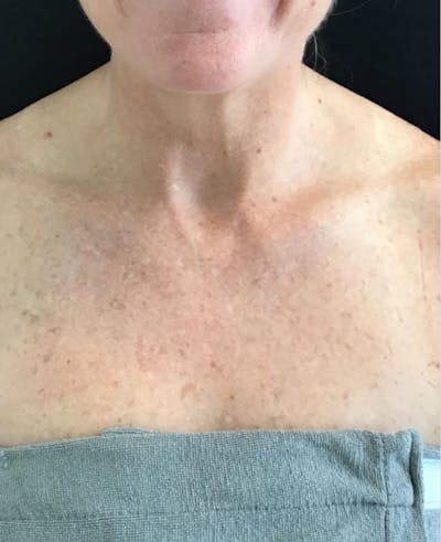 IPL Photofacial Before & After Gallery - Patient 550576 - Image 1