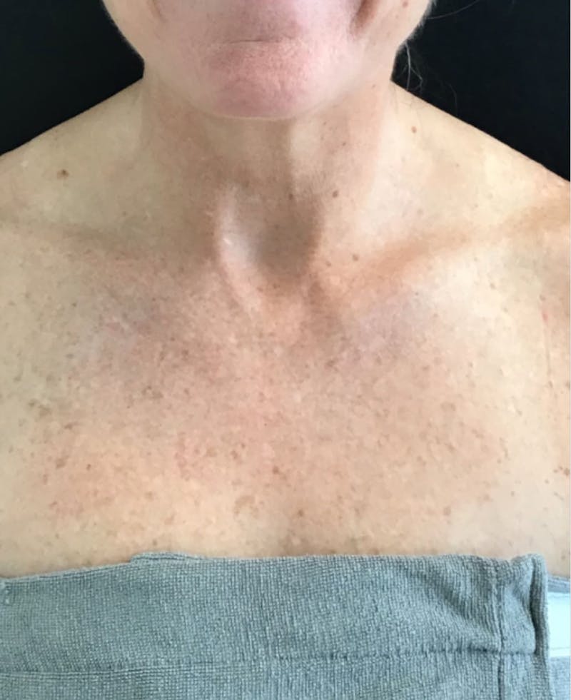 IPL Photofacial Before & After Gallery - Patient 550576 - Image 1