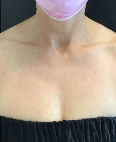 IPL Photofacial Before & After Gallery - Patient 550576 - Image 2