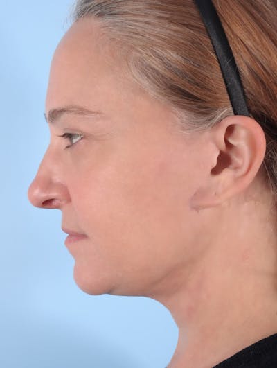 Earlobe Repair Before & After Gallery - Patient 256546 - Image 2