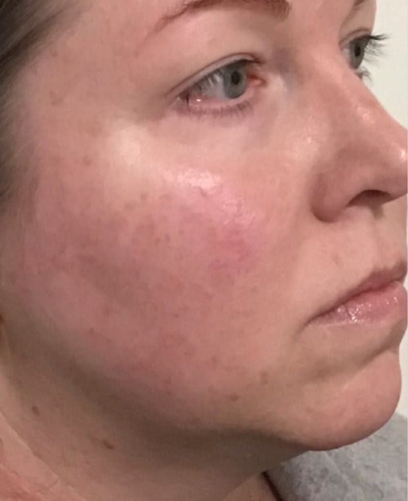 IPL Photofacial Before & After Gallery - Patient 351676 - Image 3