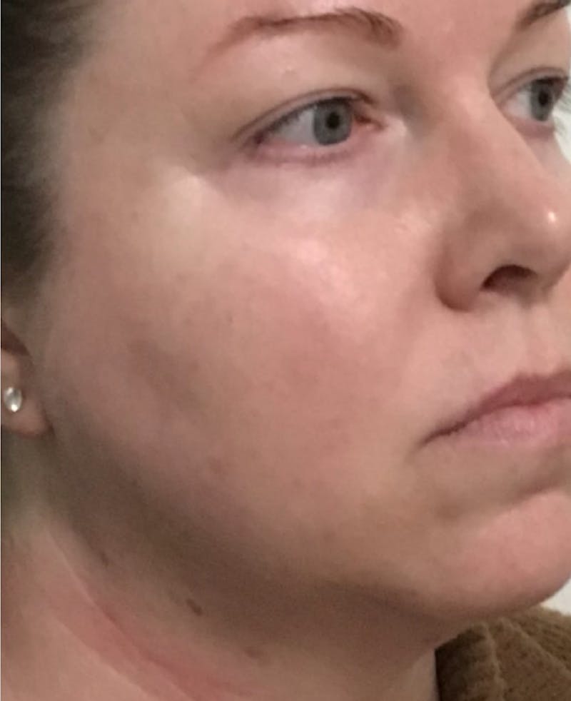IPL Photofacial Before & After Gallery - Patient 351676 - Image 4