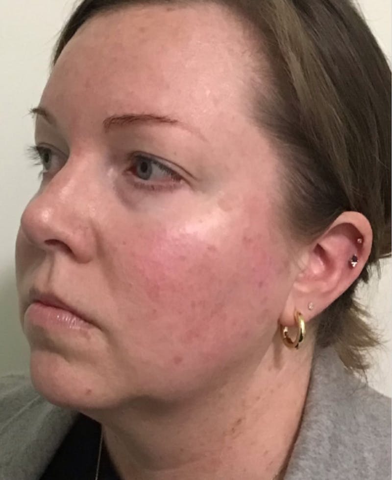 IPL Photofacial Before & After Gallery - Patient 351676 - Image 5