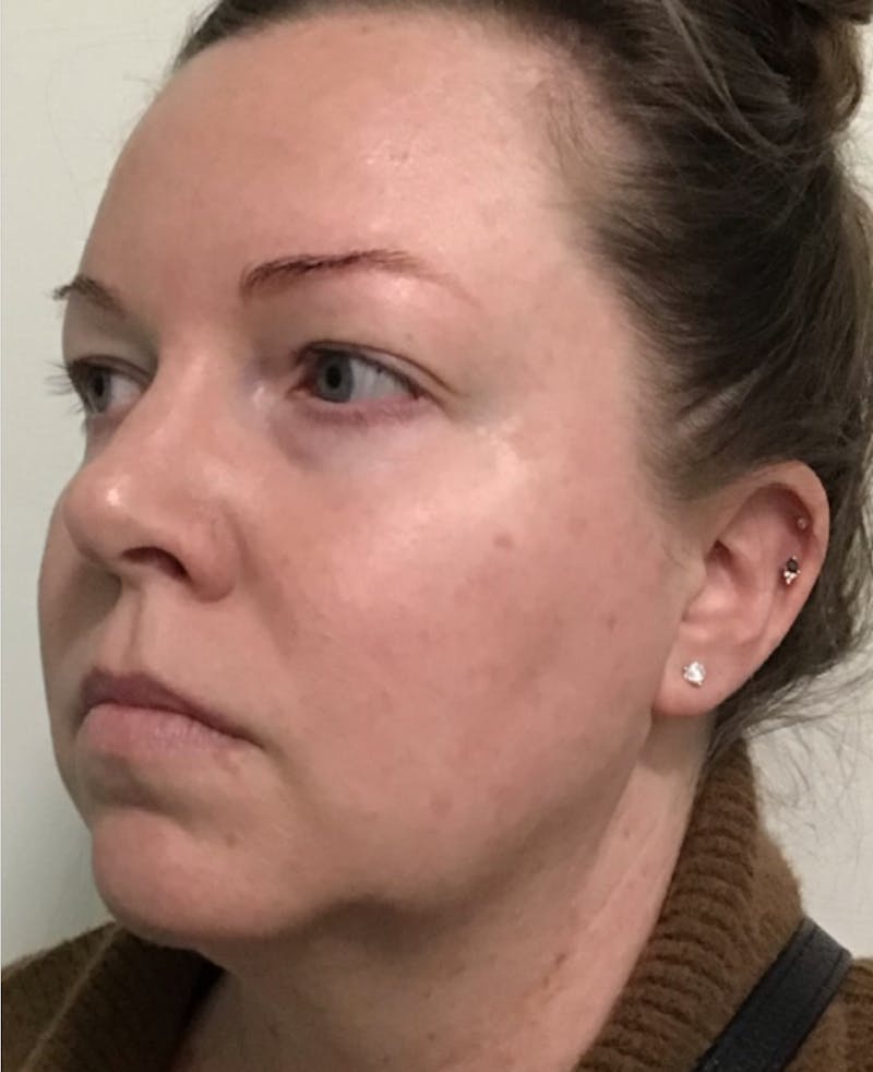 IPL Photofacial Before & After Gallery - Patient 351676 - Image 6