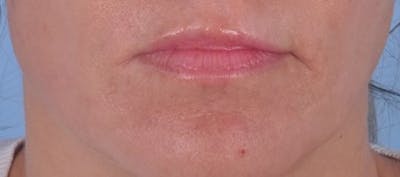 Dermal Fillers Before & After Gallery - Patient 231105 - Image 1