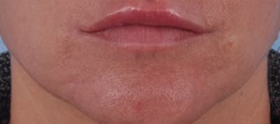 Dermal Fillers Before & After Gallery - Patient 231105 - Image 2
