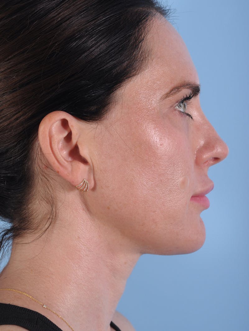 Dermal Fillers Before & After Gallery - Patient 136027 - Image 1