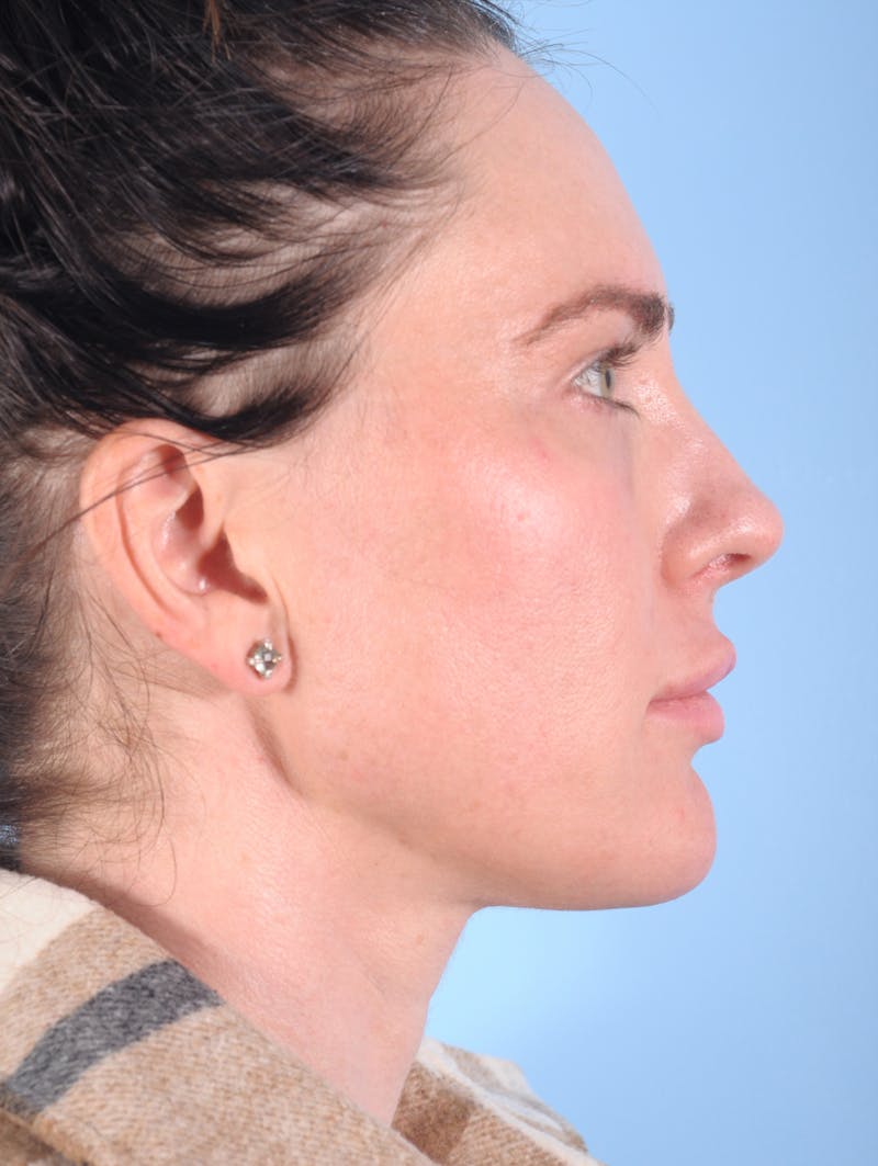Dermal Fillers Before & After Gallery - Patient 136027 - Image 2