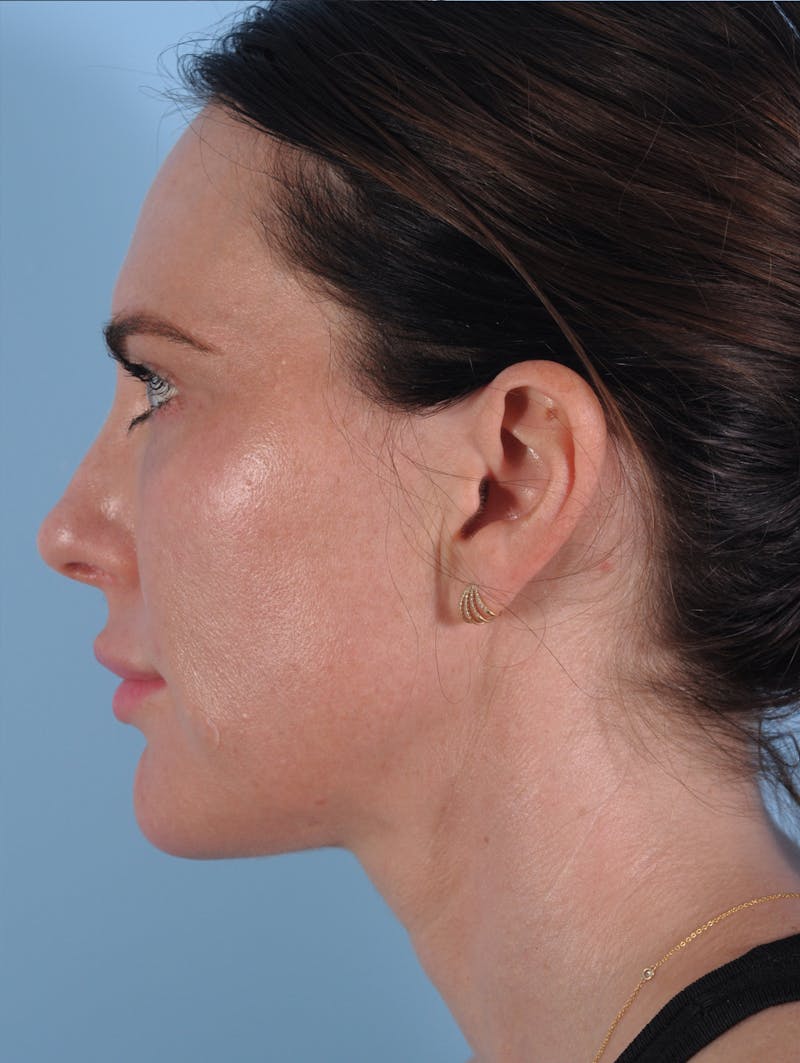 Dermal Fillers Before & After Gallery - Patient 136027 - Image 3