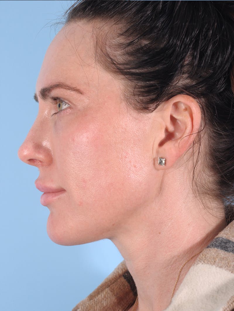 Dermal Fillers Before & After Gallery - Patient 136027 - Image 4