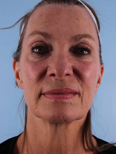 Facelift Before & After Gallery - Patient 428490 - Image 1