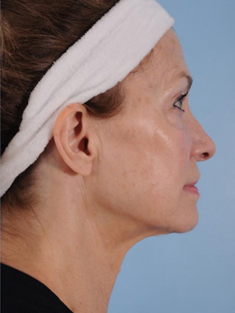 Facelift Surgery  Before & After Gallery - Patient 428490 - Image 4