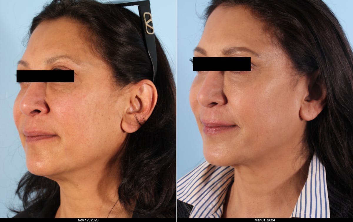 Scarlet RF Microneedling Before & After Gallery - Patient 138915 - Image 2