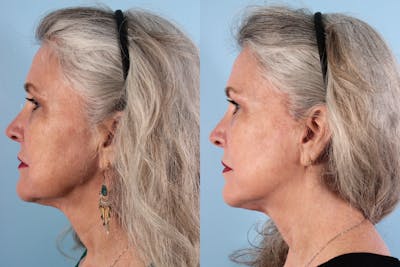 Thread Lift Before & After Gallery - Patient 300303 - Image 1