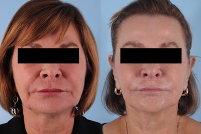 Kybella Before & After Gallery - Patient 350405 - Image 1