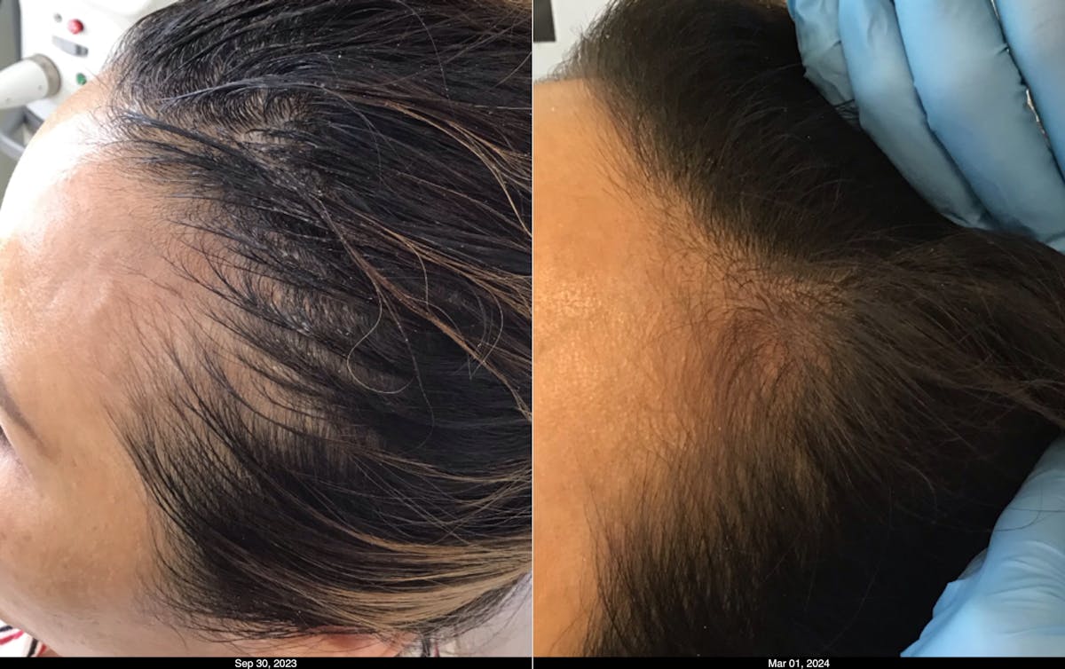 Hair Graft Surgery Before & After Gallery - Patient 391196 - Image 1