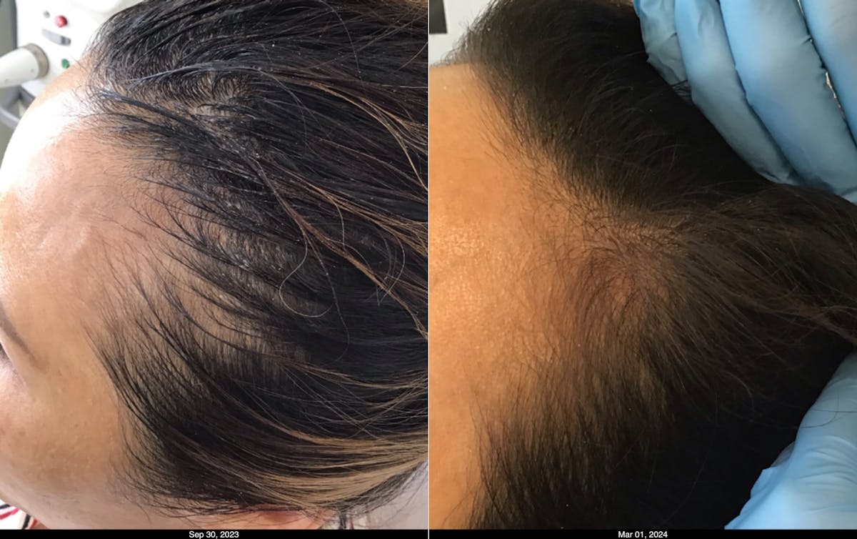 Hair Graft Surgery Before & After Gallery - Patient 391196 - Image 1