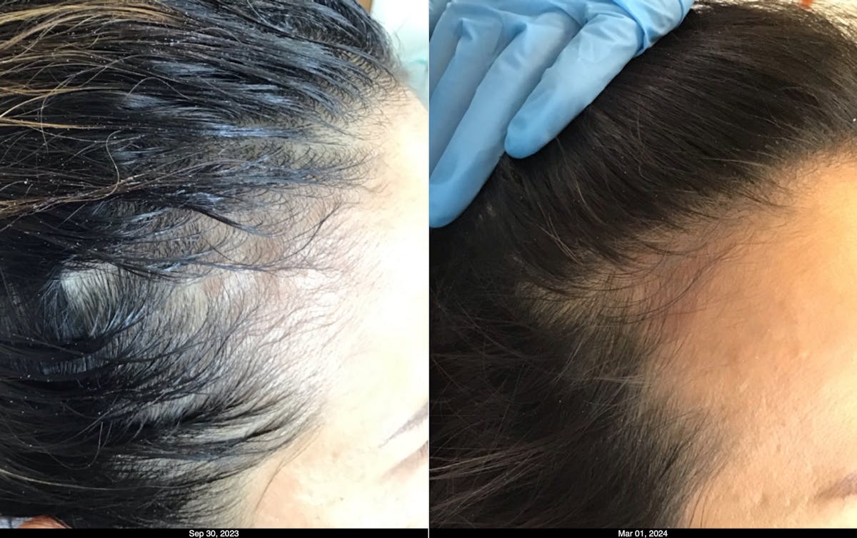 Hair Graft Surgery Before & After Gallery - Patient 391196 - Image 2