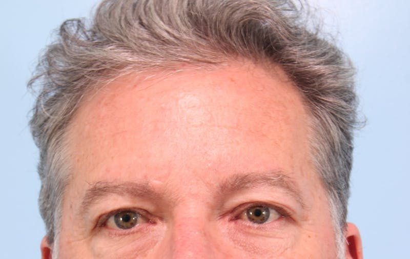 Upper Blepharoplasty Before & After Gallery - Patient 417764 - Image 1