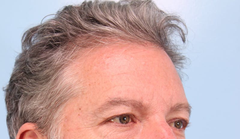 Upper Blepharoplasty Before & After Gallery - Patient 417764 - Image 3