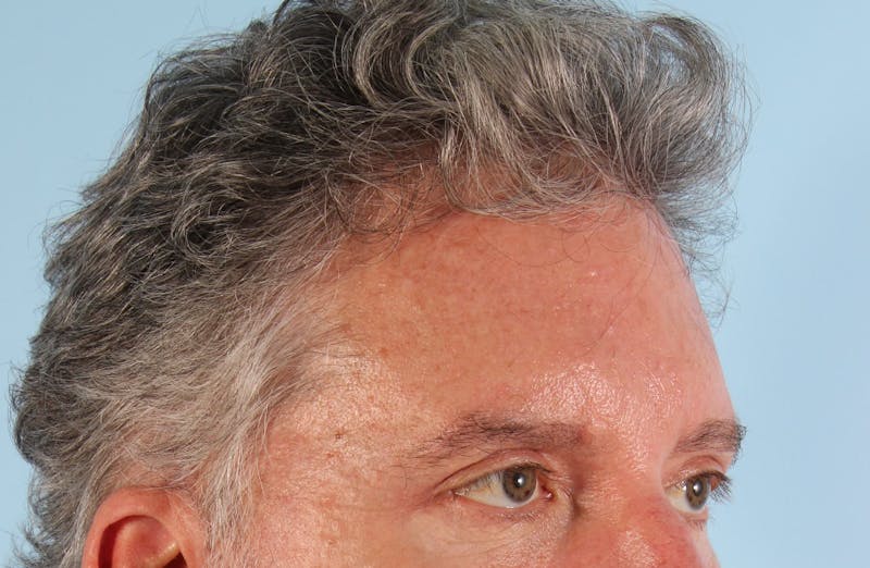 Upper Blepharoplasty Before & After Gallery - Patient 417764 - Image 4