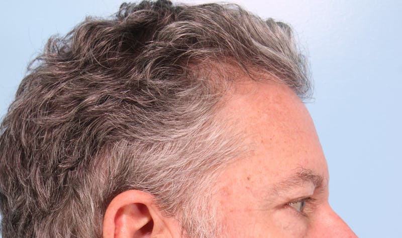 Upper Blepharoplasty Before & After Gallery - Patient 417764 - Image 5