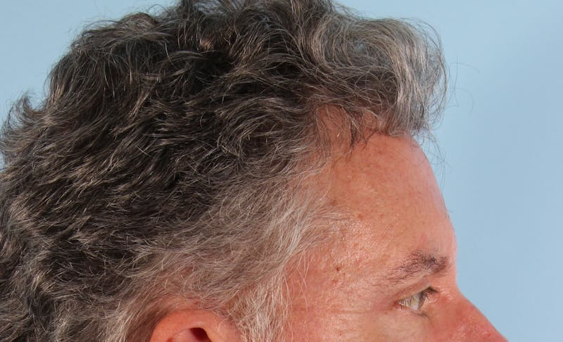 Upper Blepharoplasty Before & After Gallery - Patient 417764 - Image 6