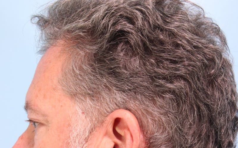 Upper Blepharoplasty Before & After Gallery - Patient 417764 - Image 7