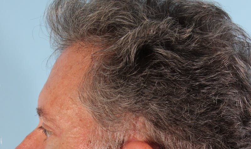 Upper Blepharoplasty Before & After Gallery - Patient 417764 - Image 8