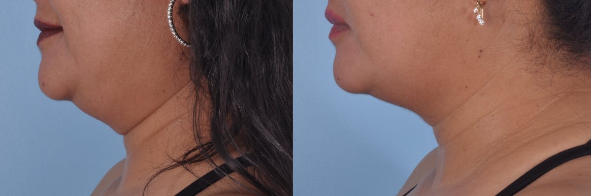 Kybella Before & After Gallery - Patient 135464 - Image 1