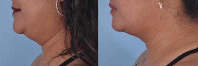Kybella Before & After Gallery - Patient 135464 - Image 1