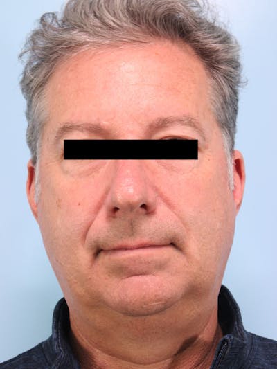 Facelift Before & After Gallery - Patient 101878 - Image 1