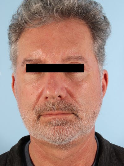 Facelift Before & After Gallery - Patient 101878 - Image 2