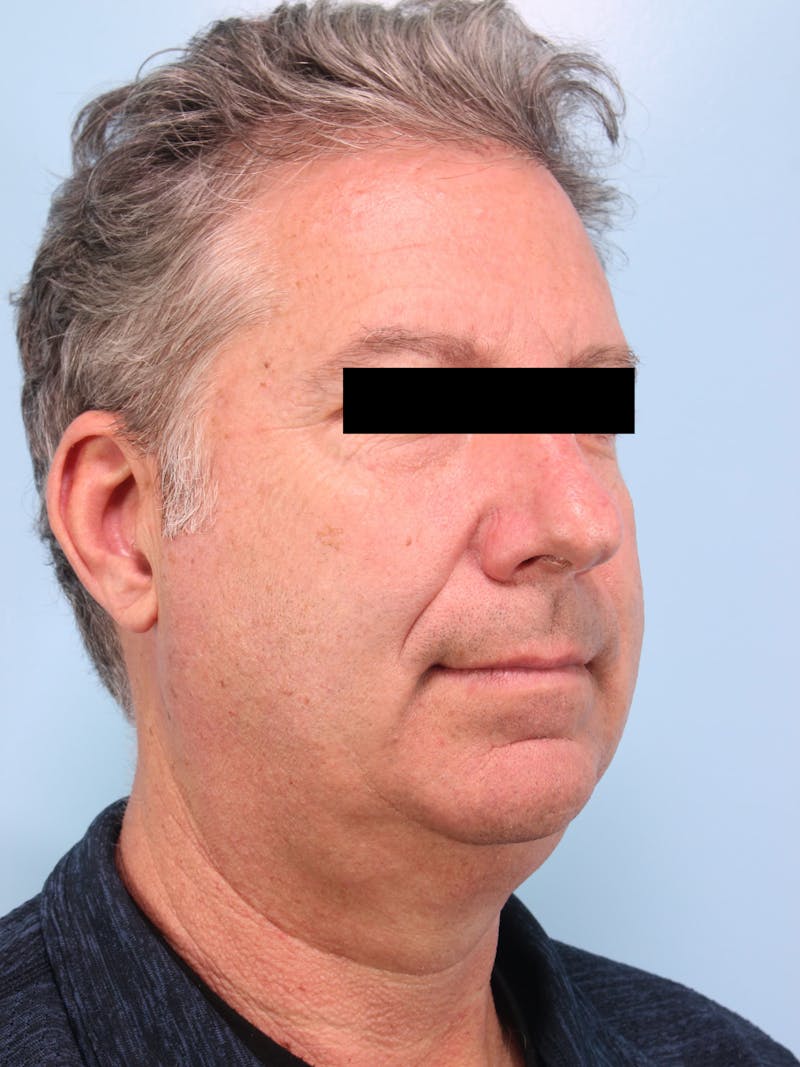 Facelift Before & After Gallery - Patient 101878 - Image 3