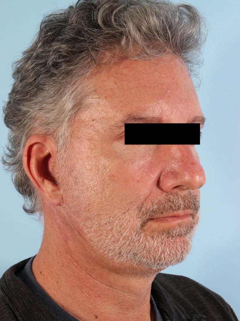 Facelift Before & After Gallery - Patient 101878 - Image 4