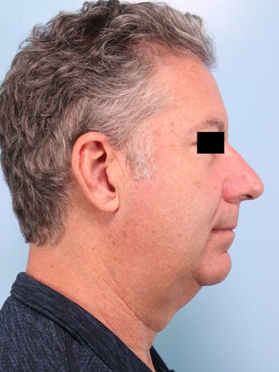 Liposuction Submental Before & After Gallery - Patient 333862 - Image 1