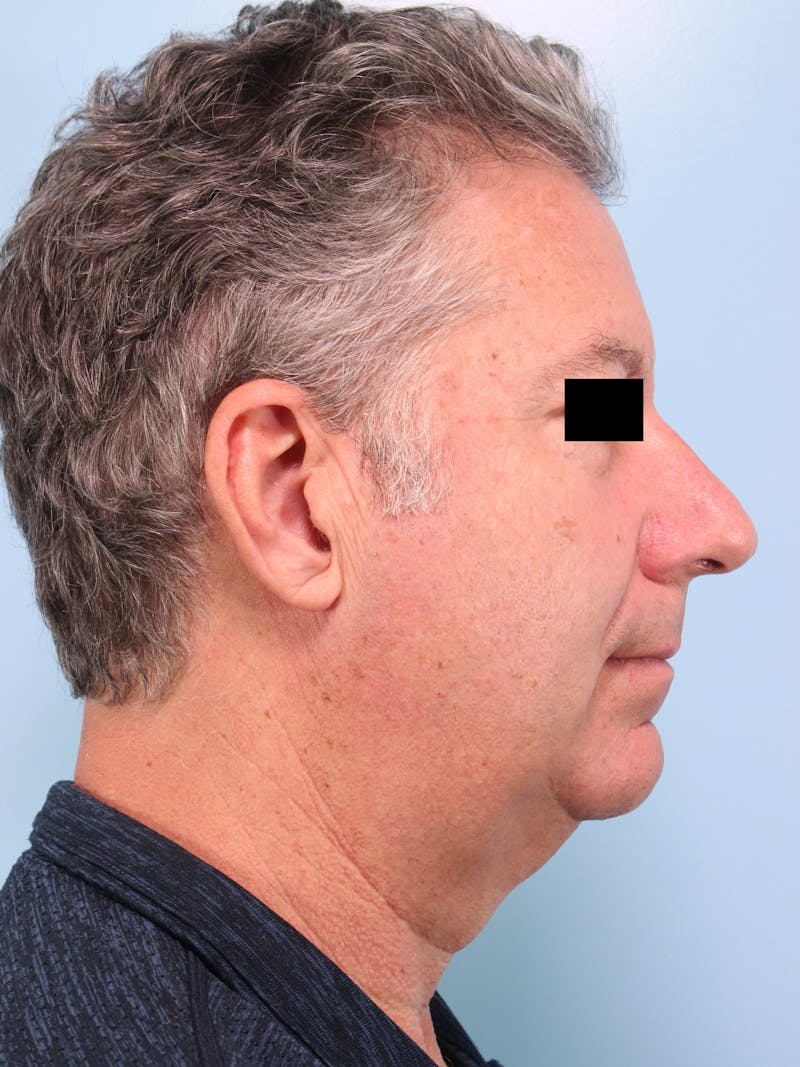 Facelift Before & After Gallery - Patient 101878 - Image 5