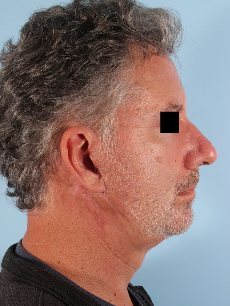 Facelift Before & After Gallery - Patient 101878 - Image 6