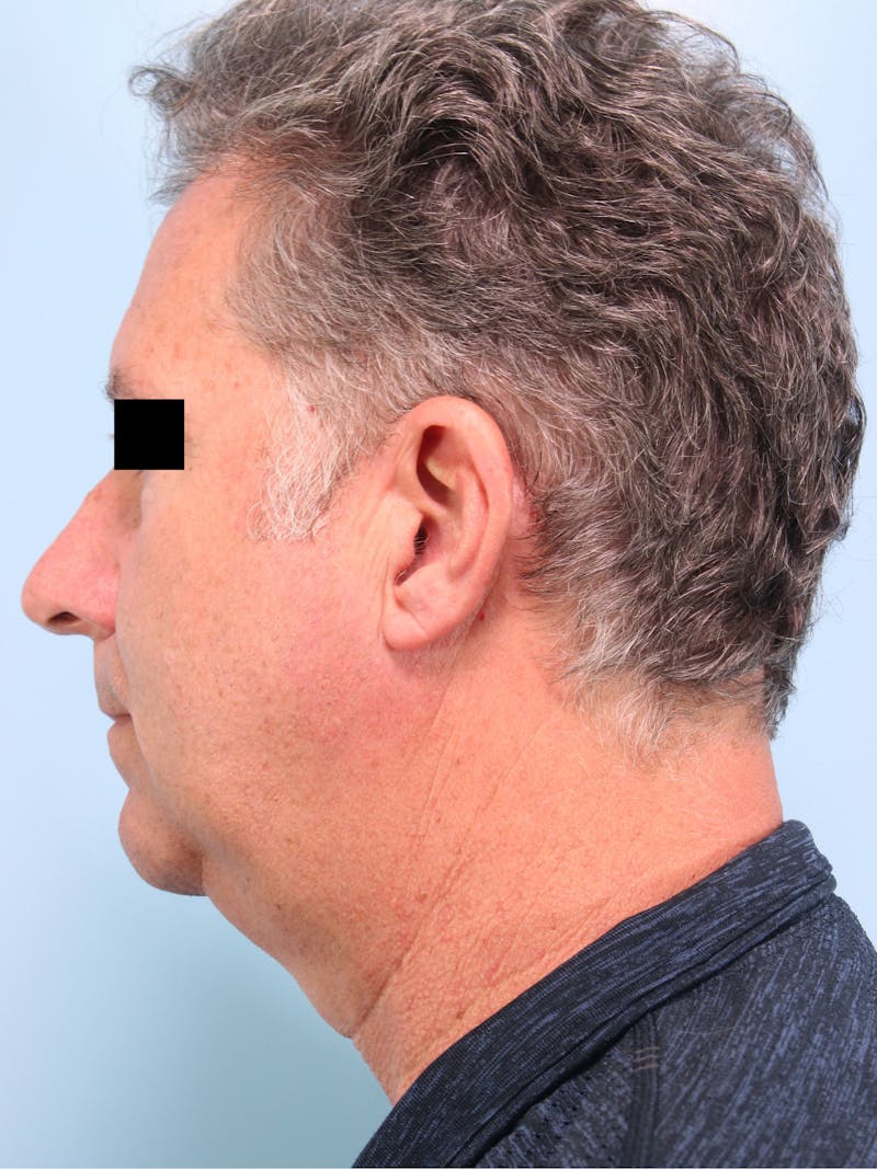 Liposuction Submental Before & After Gallery - Patient 333862 - Image 7