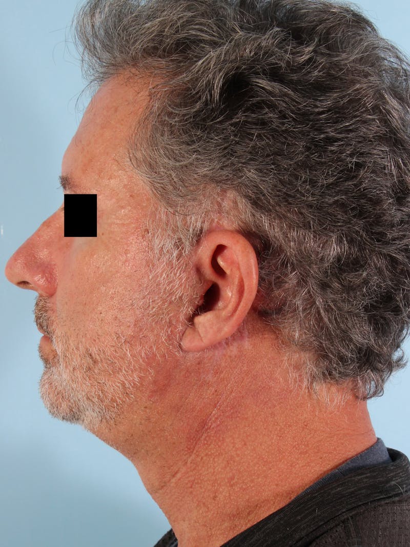 Liposuction Submental Before & After Gallery - Patient 333862 - Image 8